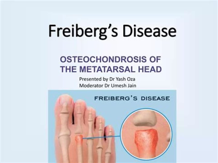 What is Freiberg's disease?