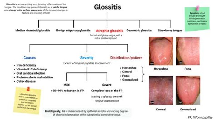 What is glossitis disease?