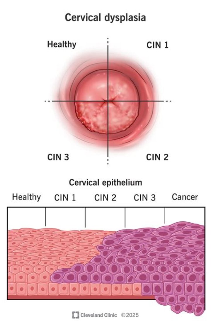 What is the difference between CIN 2 and CIN3?