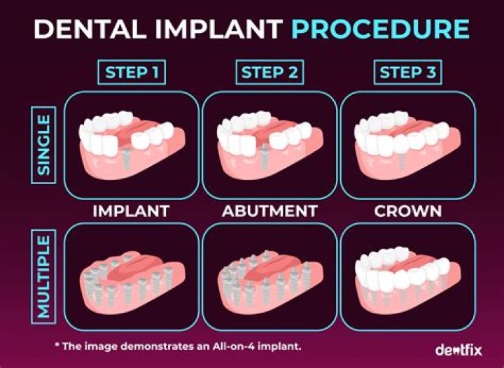 What is the scariest dental procedure?