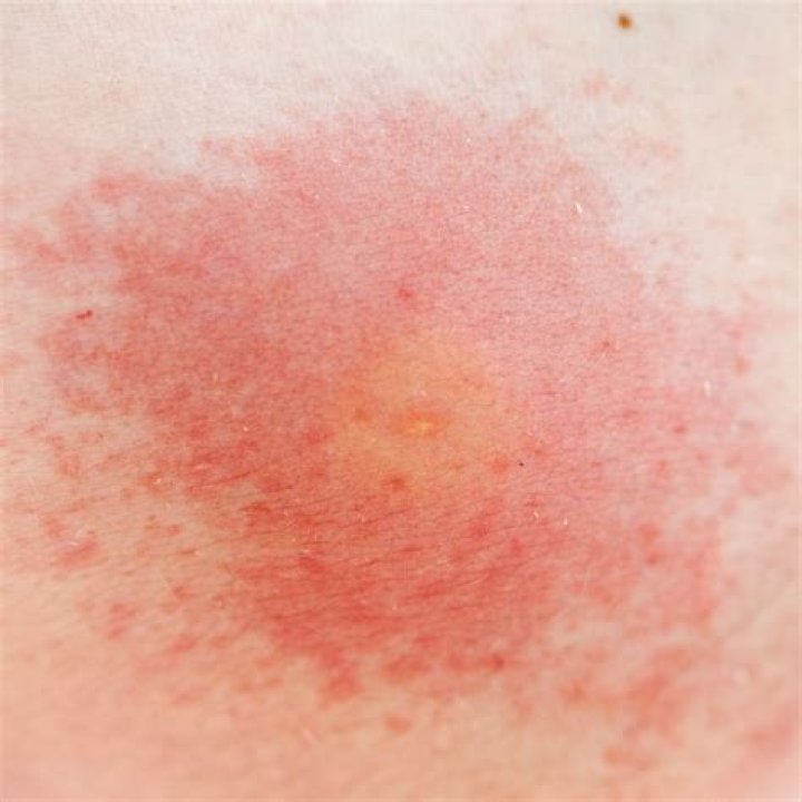 What kind of rash turns into scabs?