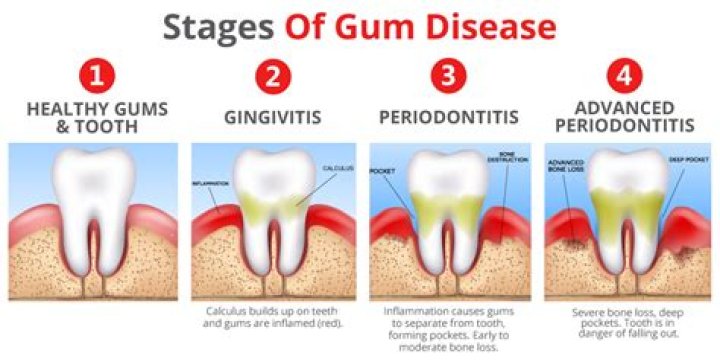 When does gingivitis become periodontitis?