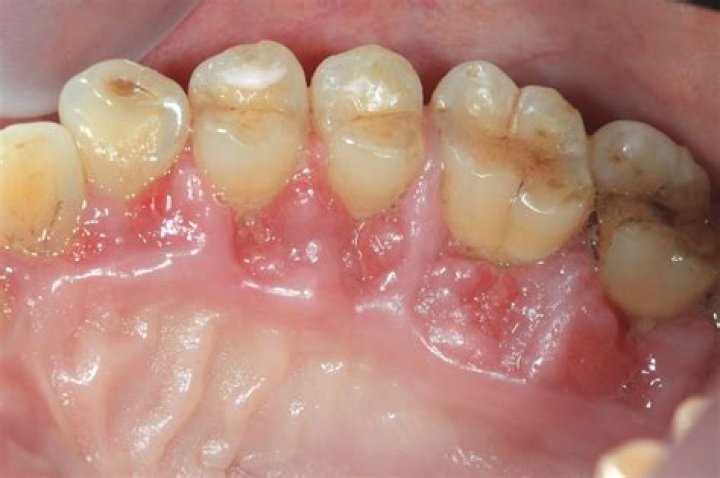 When is it too late for gingivitis?
