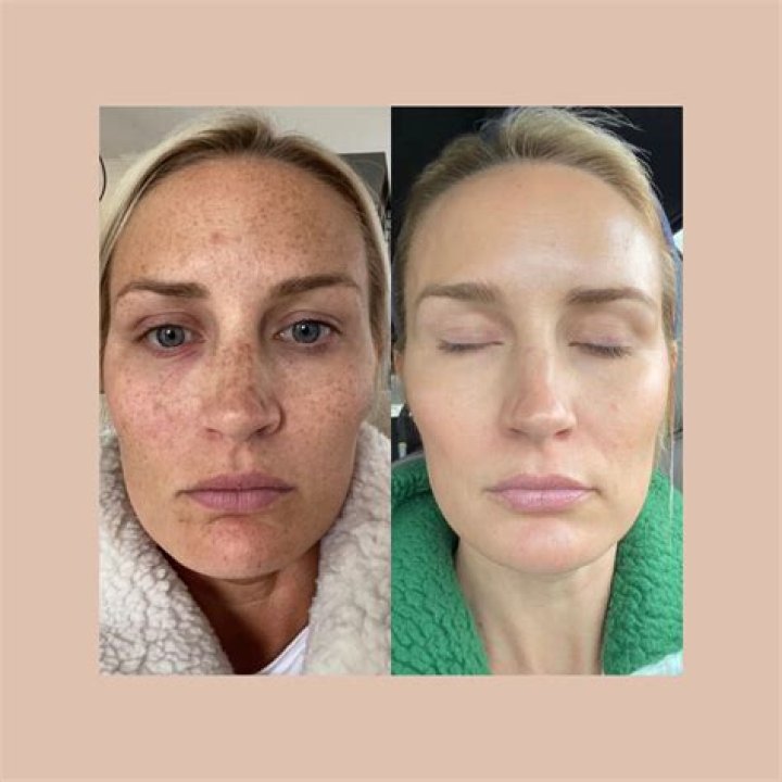 Which oil is good for pigmentation on face?