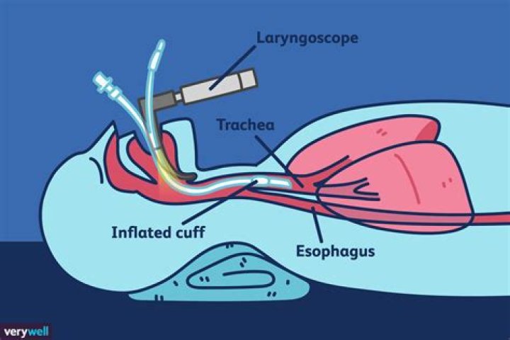 Why do they put a pipe down your throat during surgery?