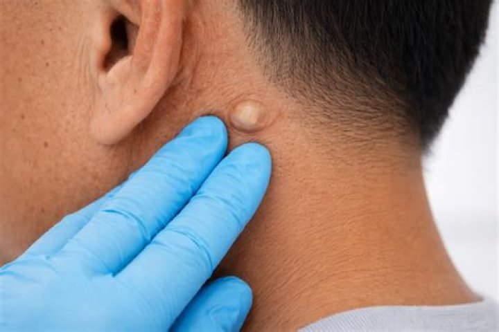 Why does cyst pus stink?