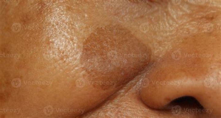 Why is it called Tufts syndrome?