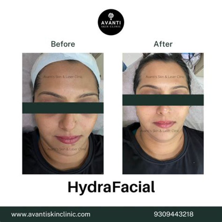 Why is my face so red after HydraFacial?