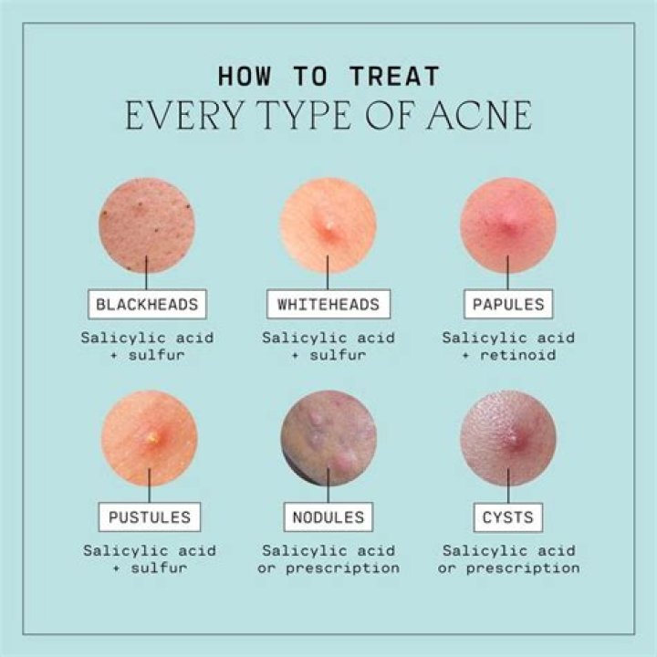 Why is my pimple green?
